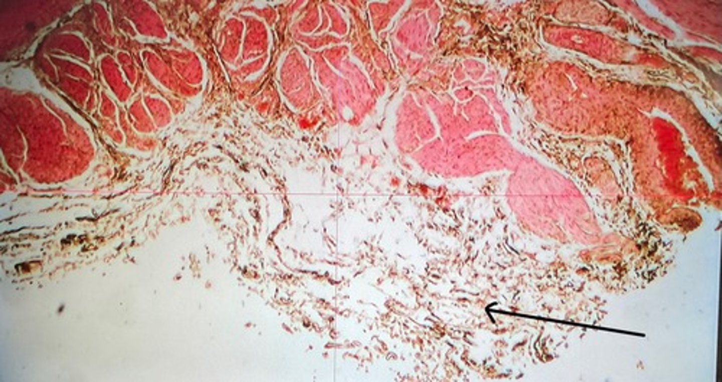 <p>ONLY on the DOME of the bladder</p>