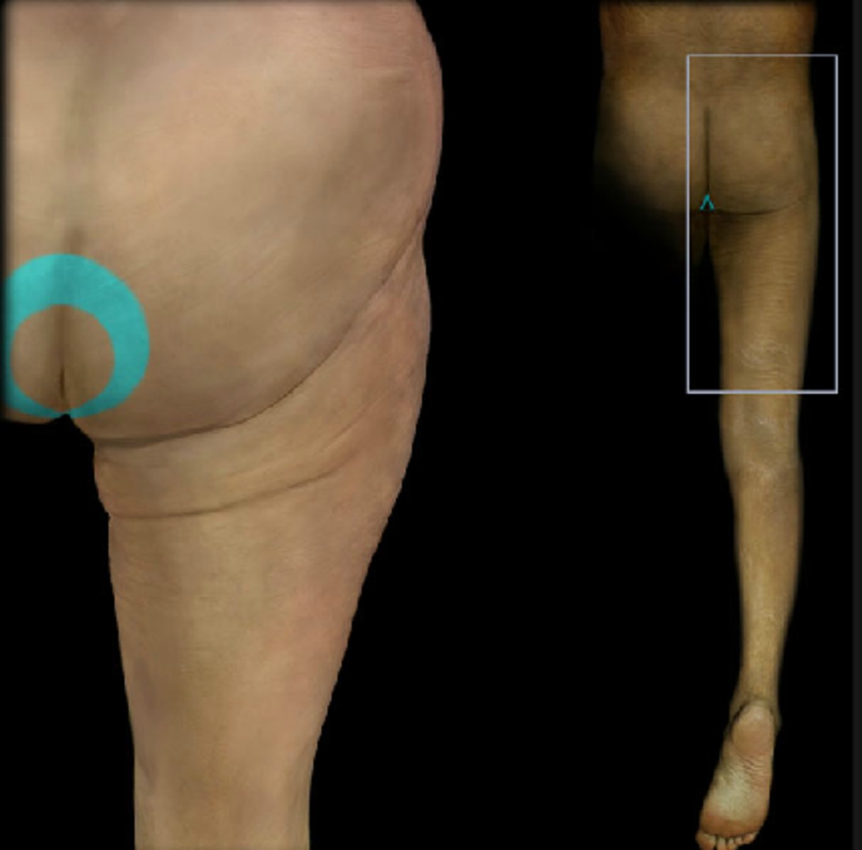 <p>Dermatome: Perineum, genitals, lower sacrum</p><p>Muscles innervated: Bladder, rectum</p><p>Reflexes (if any): None</p><p>Paresthesias: Saddle area, genitals, anus, impotence, posterior herniation</p>