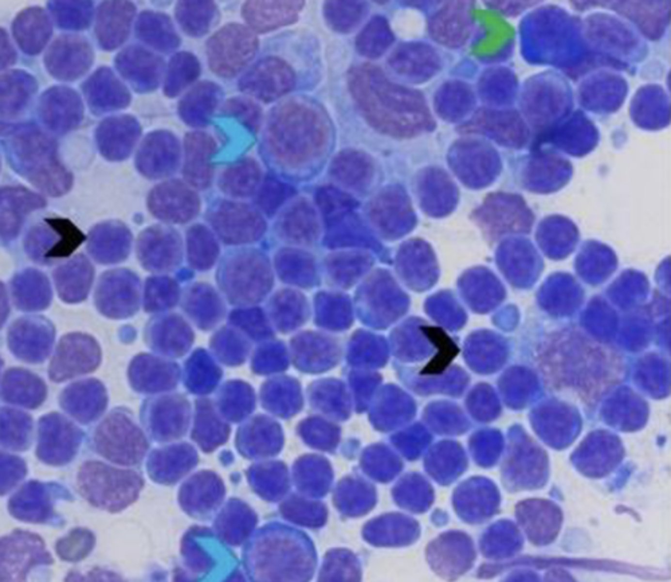 <p>What type of inflammatory cell is this?</p>