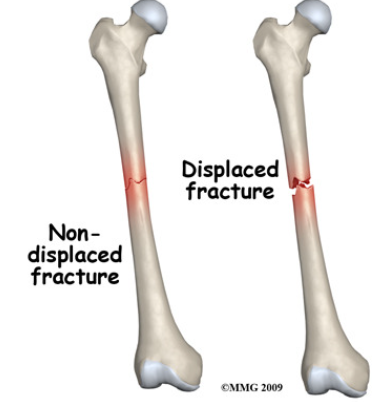 Position of bone ends after fracture

__: ends retain the normal position