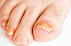 <p>What does Onycholysis indicate?</p>