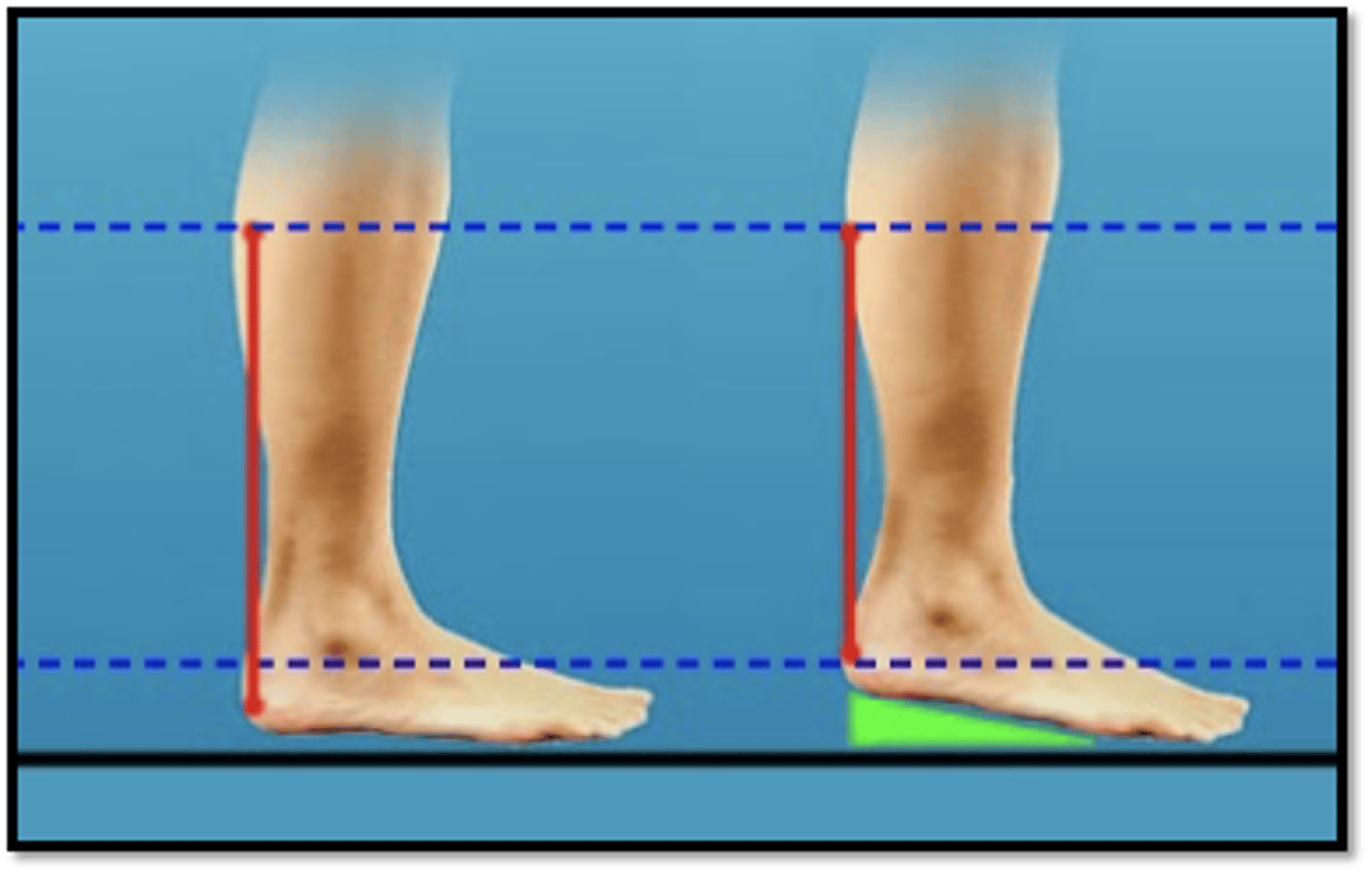 <p>4/6 -12 weeks</p><p>-weaning orthosis but add 1-1.5 cm heel lift in shoe at 6-8 week mark to transition into normal foot wear again</p><p>-Grade 3 mobs</p><p>-Self-stretch and AROM</p><p>-OKC strengthening of hip, knee, ankle and CKC heel raises</p><p>-balance and gait</p>