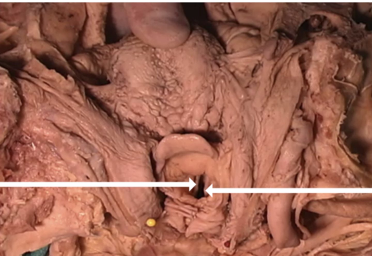 <p>-larynx</p><p>-epiglottis</p><p>-superior vocal fold</p><p>-true vocal fold</p>