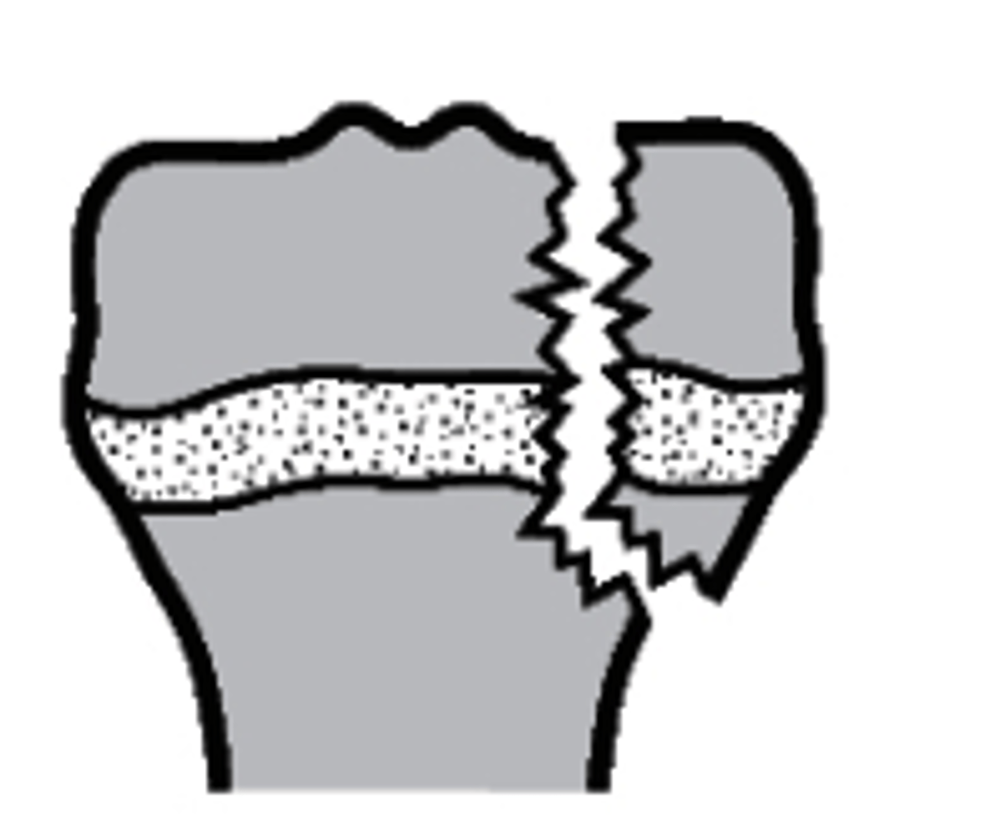 <p>what type of Salter-Harris fracture is this?</p><p>a. Type I</p><p>b. Type III</p><p>c. Type IV</p><p>d. Type II</p>
