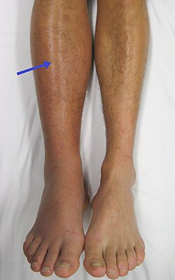 <p>Deep vein thrombosis (DVT)</p>