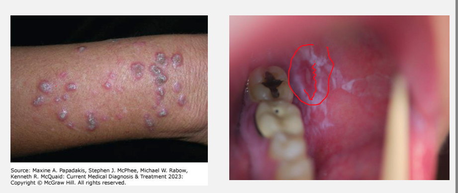 <ul><li><p><strong>Koebner phenomenon:</strong> new lesions at trauma sites</p></li><li><p><strong>Mucosal involvement:</strong> mouth, tongue, genitals (Wickham’s striae – fine white lines)</p></li><li><p>May cause <strong>alopecia</strong> and <strong>nail dystrophy</strong></p></li></ul><p></p>