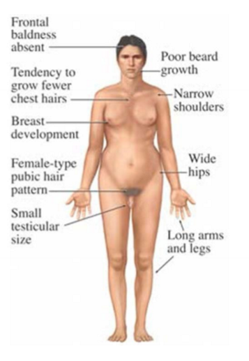 <p>47 XXY, 1 in 1000 males, infertility (atrophic testes don’t produce sperm), poorly developed 2ry sexual characteristics, tall</p>