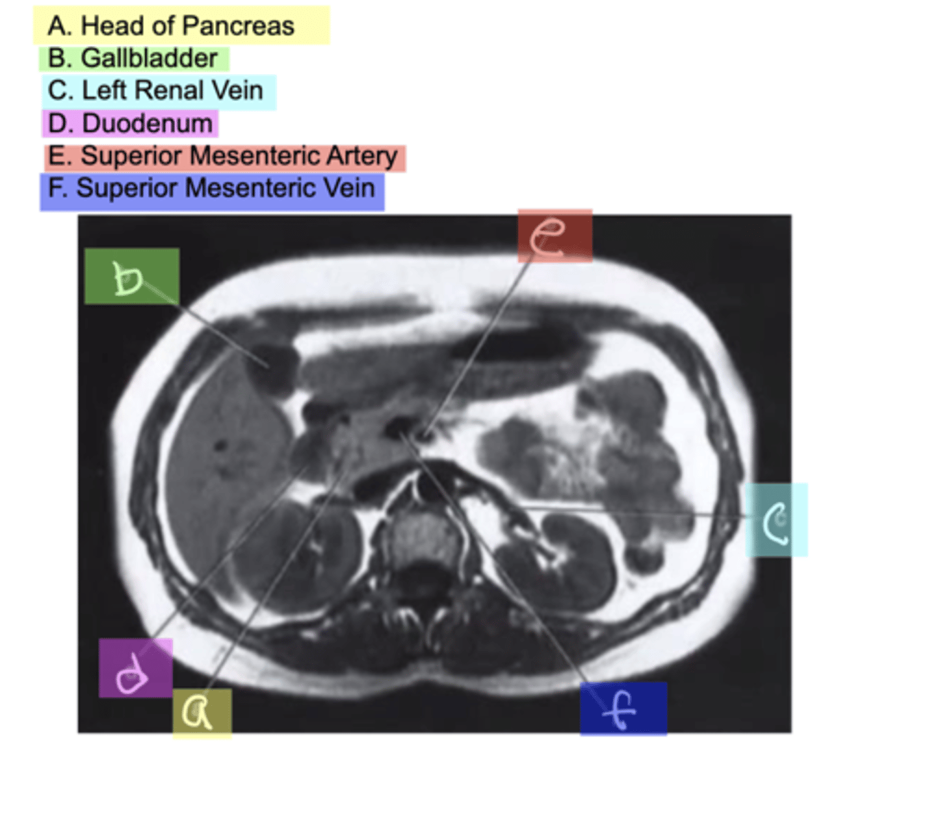 <p>A. Head of Pancreas</p><p>B. Gallbladder</p><p>C. Left Renal Vein</p><p>D. Duodenum</p><p>E. Superior Mesenteric Artery</p><p>F. Superior Mesenteric Vein</p>