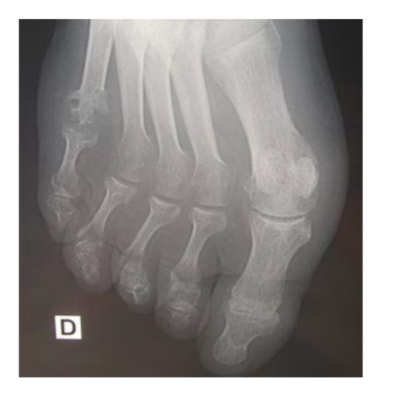 <ul><li><p>destruction articulaire de la 5e MTP avec érosions multiples </p></li></ul><p></p>