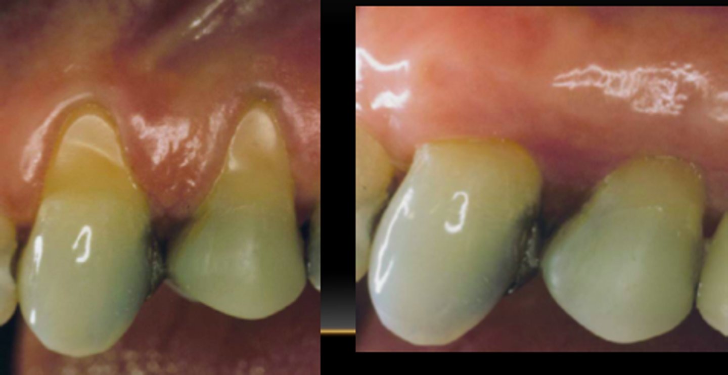 <p>the drawing back of the gingiva from the neck of the teeth, exposing the root surfaces.</p><p>Sign of periodontal diseases</p>
