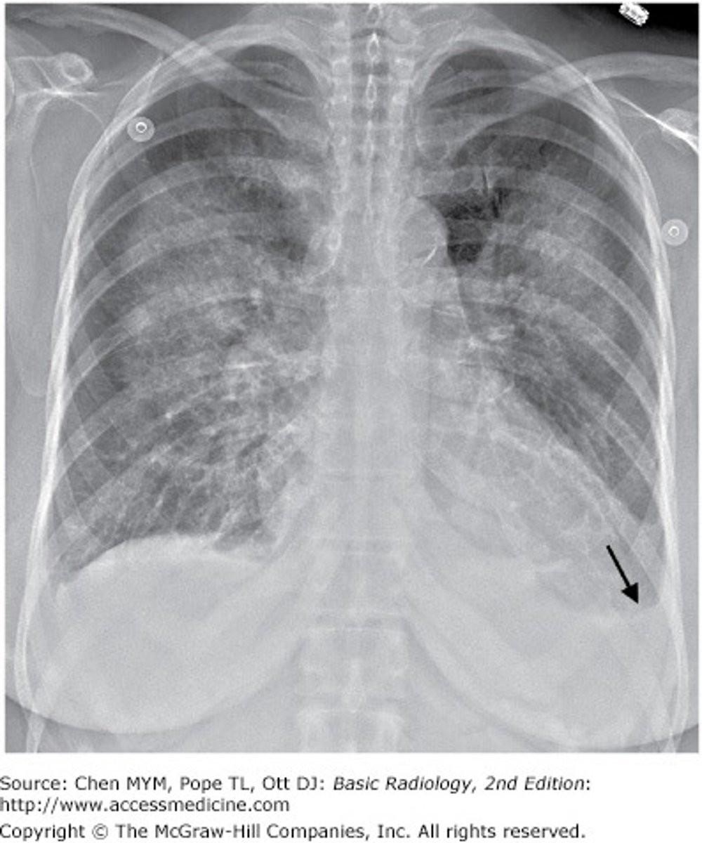 <p>The Correct Answer is: B</p><p>The patient has developed a pleural effusion most likely due to CHF based on the symptoms and presence of small bilateral pleural effusions. Initial interventions include diuresis and monitoring for resolution of symptoms and the effusion (B). If the effusion fails to improve or the patient develops dyspnea at rest then thoracentesis (E) is indicated. Additional therapy or intervention (A, C, E) should be considered if the patient's condition worsens and are informed by the results of thoracentesis.</p>