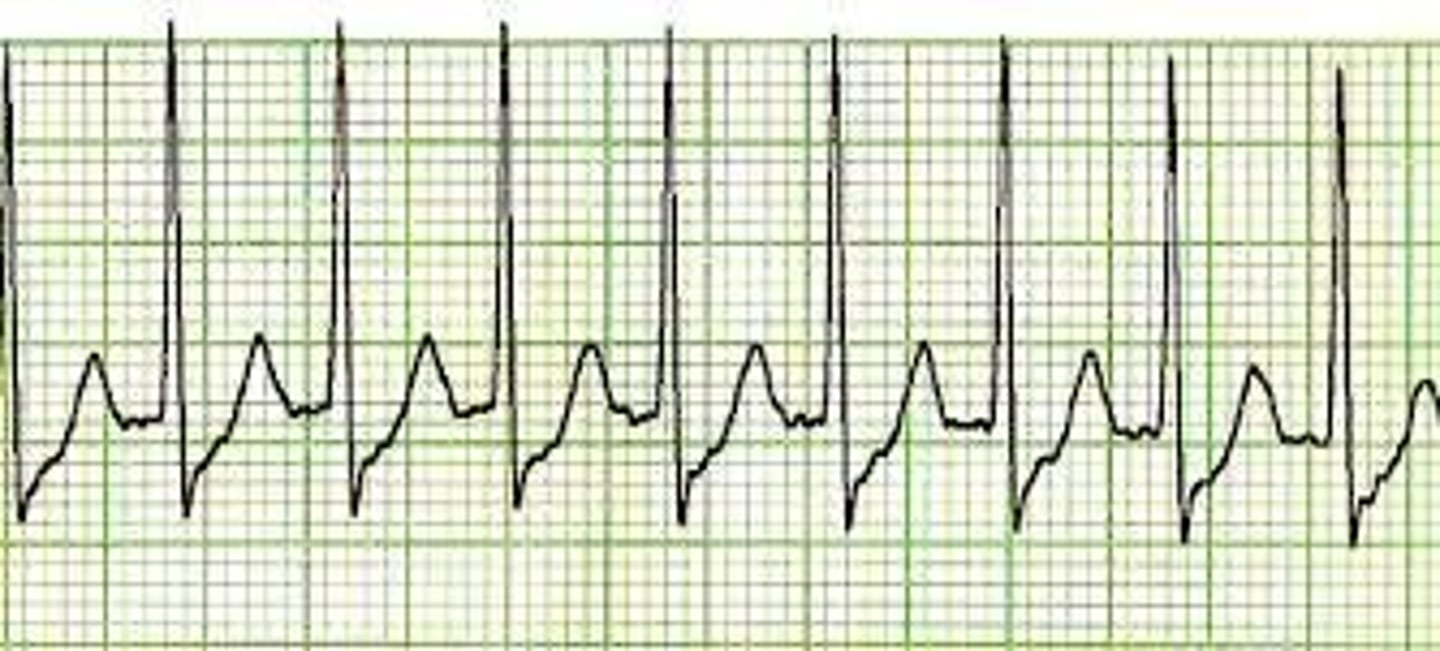 <p>All the same like NSR except HR less than 60 bpm</p>