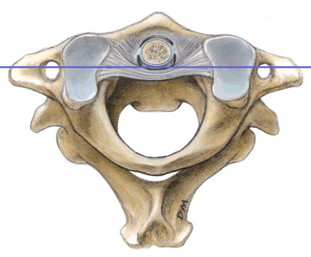 <ul><li><p>processus odontoïde de C2 articulé vers l&apos;avant avec l&apos;arc antérieur de l&apos;atlas  et vers l&apos;arrière avec un ligament transverse → tendu entre masse latérael G/D de C1</p></li><li><p>processus odontoïde maintenu par des ligaments alaires</p></li></ul>