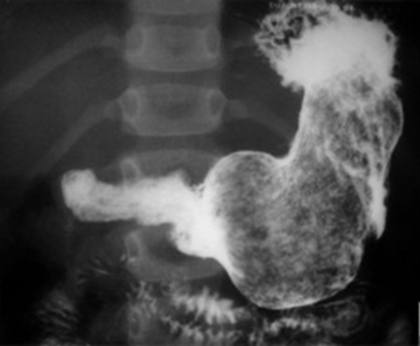 <p>Diagnosis: US or CT</p><p>Treatment: endoscopic removal</p>