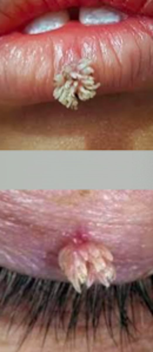 <p>Viral Skin Infections:</p><p>- long, narrow projections 1-2 mm from the skin</p><p>- skin-colored to brown</p><p>- typically found on eyelids, ears, and lips</p><p>- <strong>resemble coral reef</strong></p><p>- <strong>rarely form in clusters</strong></p>