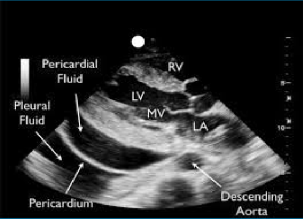 <p>Abnormal accumulation of pericardial fluid.</p><p>May be diffuse or loculated.</p><p>Fluid accumulation leads to an increased intrapericardial pressure, which can negatively affect heart function.</p>