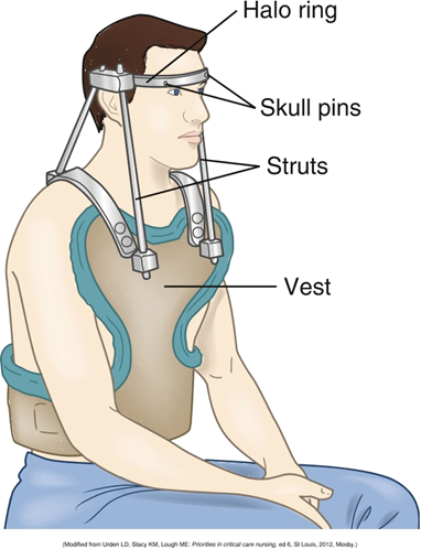<ul><li><p>Used for immobilization with spinal fractures</p></li><li><p>Allows movement and ambulation while bones fuse </p></li><li><p><strong><u>Pin Site Care</u></strong></p></li></ul><p></p>