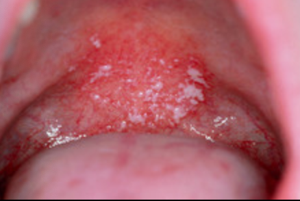 <p>1d.What is a defining feature of <span>Pseudomembranous candidiasis</span>?</p>