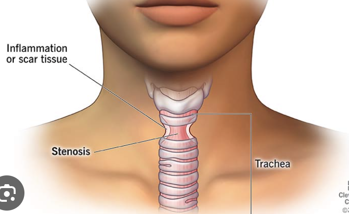 <p>Trachea</p>