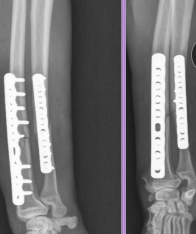 <ul><li><p><span style="background-color: transparent;"><strong><span>Considerations: </span></strong><span>No soft tissue envelope, weight-bearing, </span><strong><span>blood supply poor in </span><u><span>small breeds,</span></u><span> poor healing, Robert/modified jones bandage</span></strong></span></p></li><li><p><span style="background-color: transparent;"><strong><span>Tx: </span></strong><span>rigid fixation, often only radius tx</span></span></p><ul><li><p><span style="background-color: transparent;"><strong><span>Bone plate & screws</span></strong><span> (#1)</span></span></p><ul><li><p><span style="background-color: transparent;"><span>IM pins contraindicated for radius</span></span></p></li></ul></li><li><p>IM pins NOT in radius (cats need both)</p></li><li><p>JUST the radius in fixed(dogs) </p></li><li><p><span style="background-color: transparent;"><strong><span>External skeletal fixation</span></strong></span>→ open fractures, 1A ESF</p></li><li><p><span style="background-color: transparent;"><strong><span>Casting:</span></strong><span> acceptable if 50% reduction; best for transverse fractures in young dogs </span></span></p><ul><li><p><strong><u>NOT in toy breeds</u></strong></p></li></ul></li></ul></li></ul><p></p>