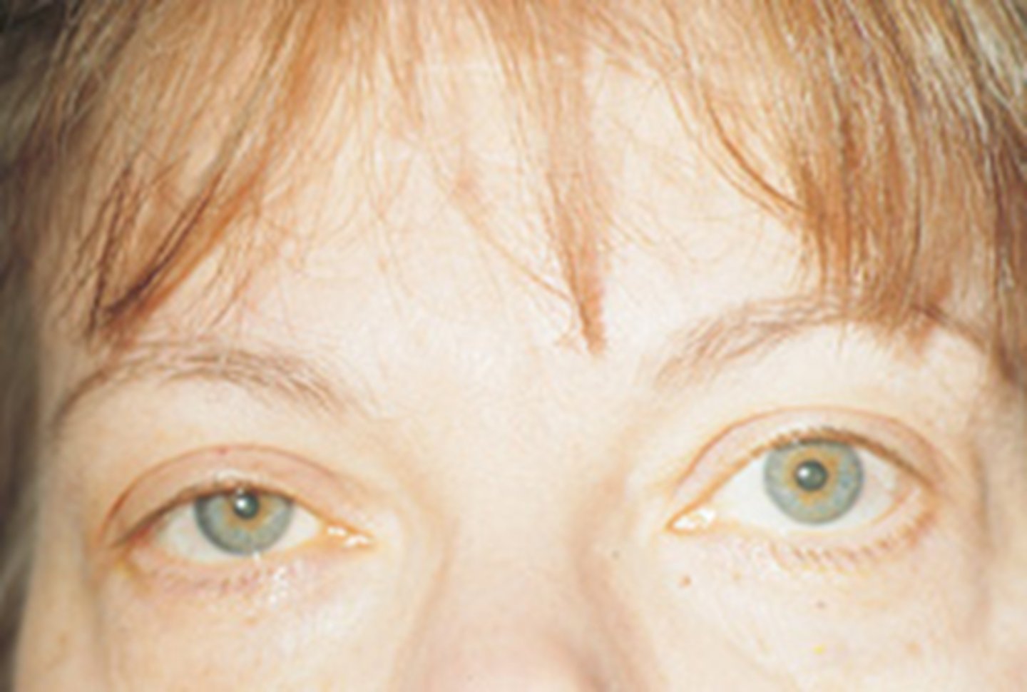 <p>ptosis, miosis, and anhydrosis with some other signs</p>