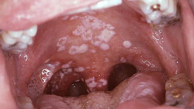<p>CANDIDIASIS </p><p>mnililiasis </p>