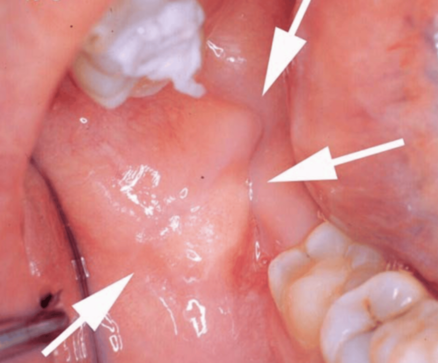 <p>buccal mucosa</p>