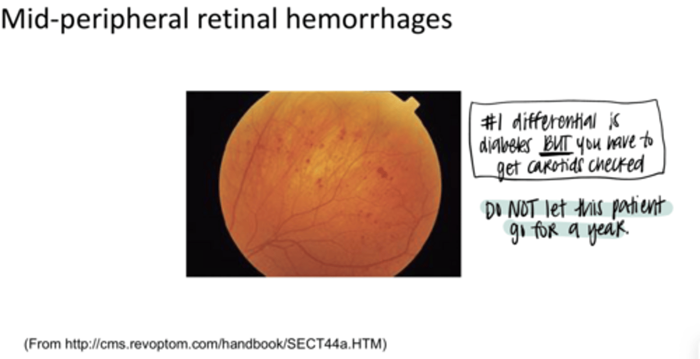 <p>Mid Peripheral Retinal Hemorrhages (Pic)</p>