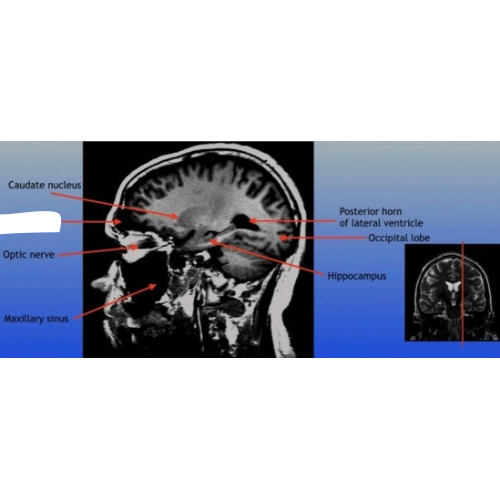 <p>A paired cavity located within the frontal bone, above the eyes, that plays a role in sinus drainage and resonance of the voice. </p>