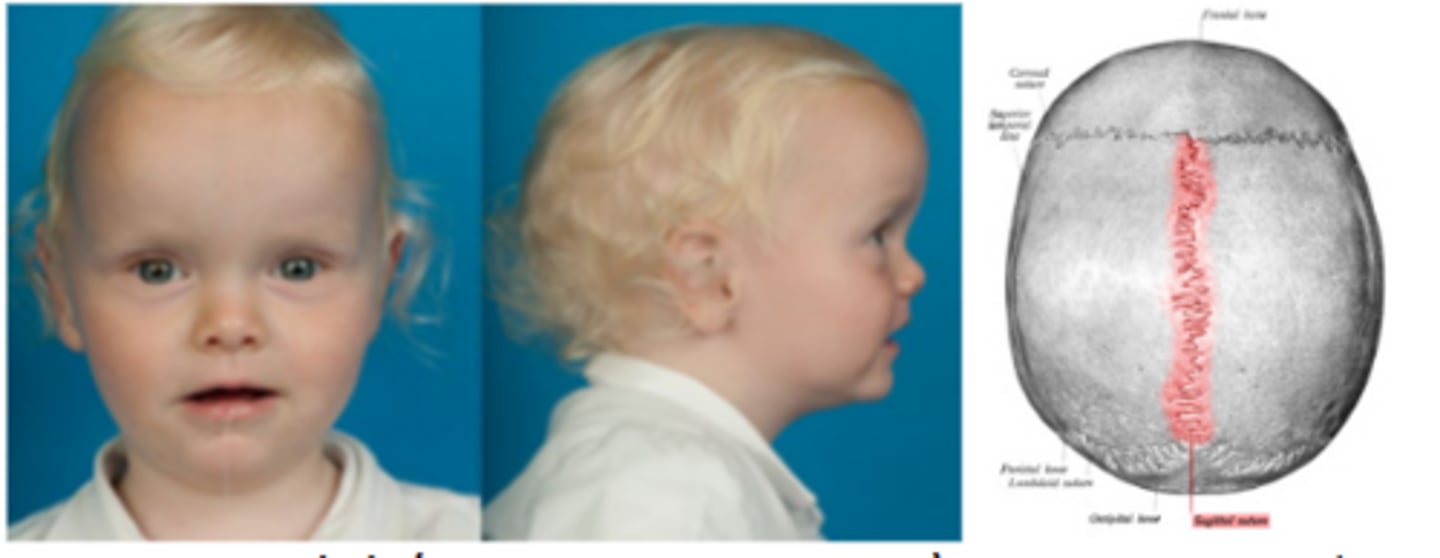 <p>premature sagittal suture fusion resulting in the elongation of the skull in the anterior-posterior direction leading to a bossing of the forehead. Is more common in boys (4:1)</p>