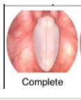 <p><span>•Touching along entire edge of vocal folds</span></p>