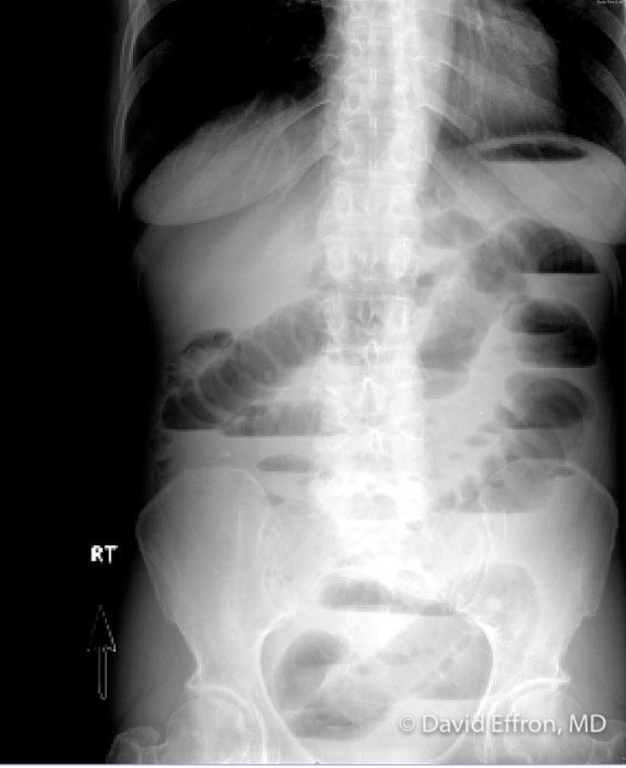 <p><span><strong>blockage causing accumulated intraluminal contents resulting in distention, bowel wall edema, eventual bowel necrosis</strong></span><br><span><em>risk factors: </em></span><br><strong>small bowel: </strong><span style="color: blue"><strong>adhesions (MCC)</strong></span><span><strong>, </strong>hernia, foreign body, radiation, malignancy</span><br><span><strong>large bowel: </strong>cancer, diverticulitis, volvulus, impaction, stricture</span></p><p><span>S/S: nausea, vomiting, pain associated with oral intake, stool changes</span><br><span>PE: abdominal auscultation (<strong>hyperactive</strong>, <strong>tinkling</strong> bowel sounds), DRE (impacted stool)</span></p><p><span>Dx: XRAY<strong>, CT imaging </strong>(air fluid levels)</span></p><p><span>Tx: NPO + Fluids, Antibiotics, <strong>Proximal decompression, </strong>Surgery consult</span></p>