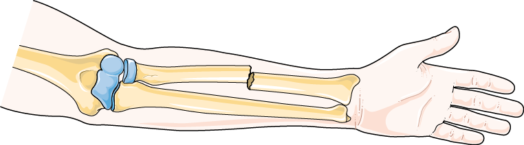 <ul><li><p>the bone is broken</p></li><li><p>the skin is NOT broken/closed </p></li></ul><p></p>