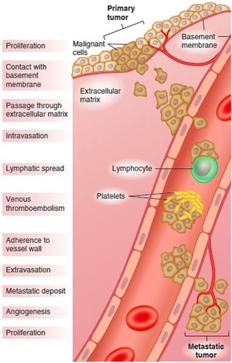 <p>Spread of cancer cells to distant body sites.</p>