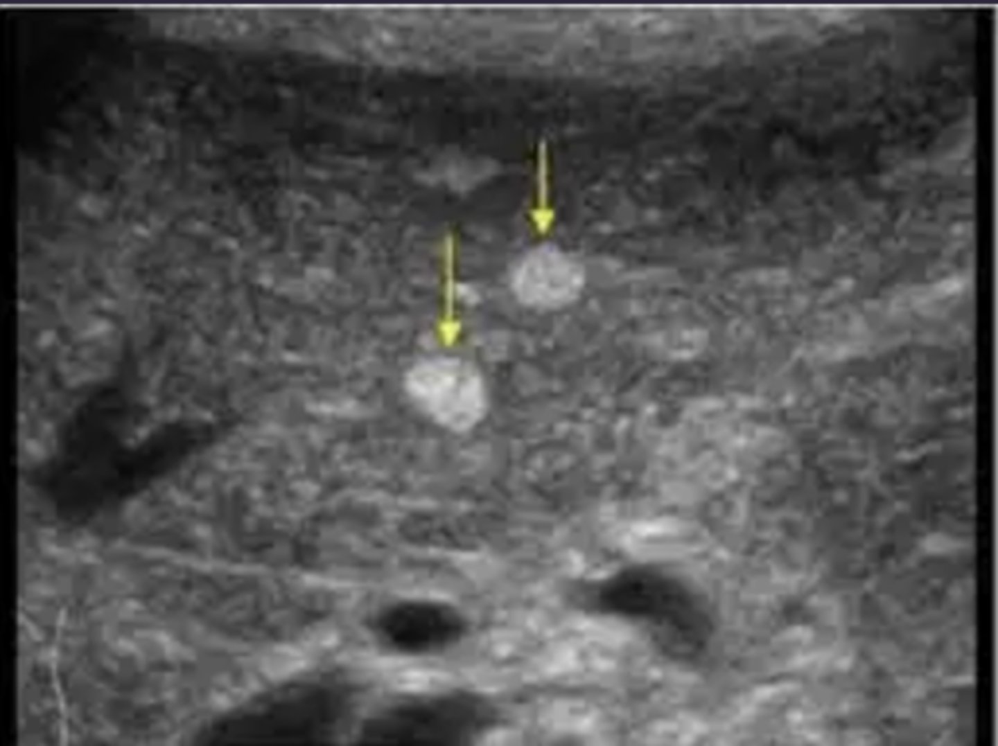 <p>which term best describes the ultrasound echogenicity of this structure?</p>
