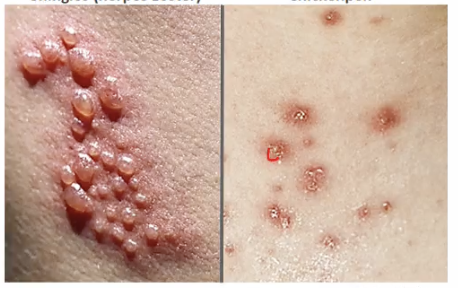 <ul><li><p><strong>Tingling and pain</strong> precede the rash.</p></li><li><p><strong>Vesicular eruption</strong> in a <strong>dermatomal pattern</strong> (follows a single nerve root).</p></li><li><p>Lesions <strong>evolve to pustules</strong>, then <strong>crust over</strong>.</p></li></ul><p><span style="color: blue;"><strong>Hint: “Chickenpox spreads; shingles stays in a line.</strong></span></p>