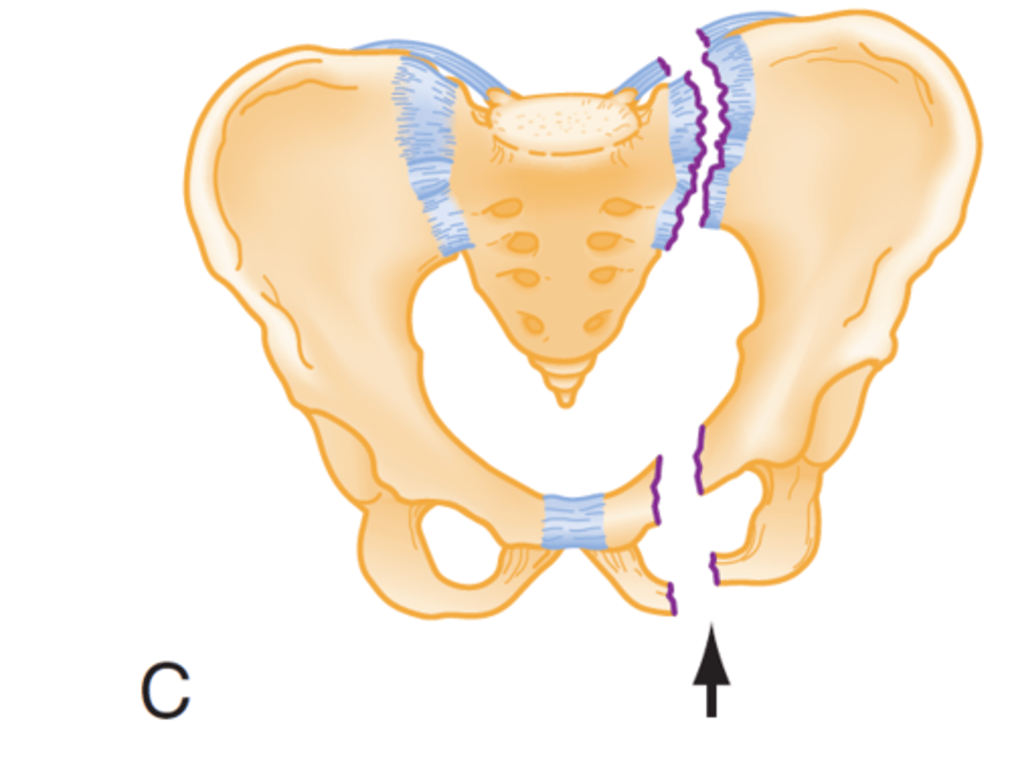 <p>disruption in pelvic girdle, SI joint, ligaments, blood vessels<br>may lead to pelvic injury instability and severe internal bleeding</p>