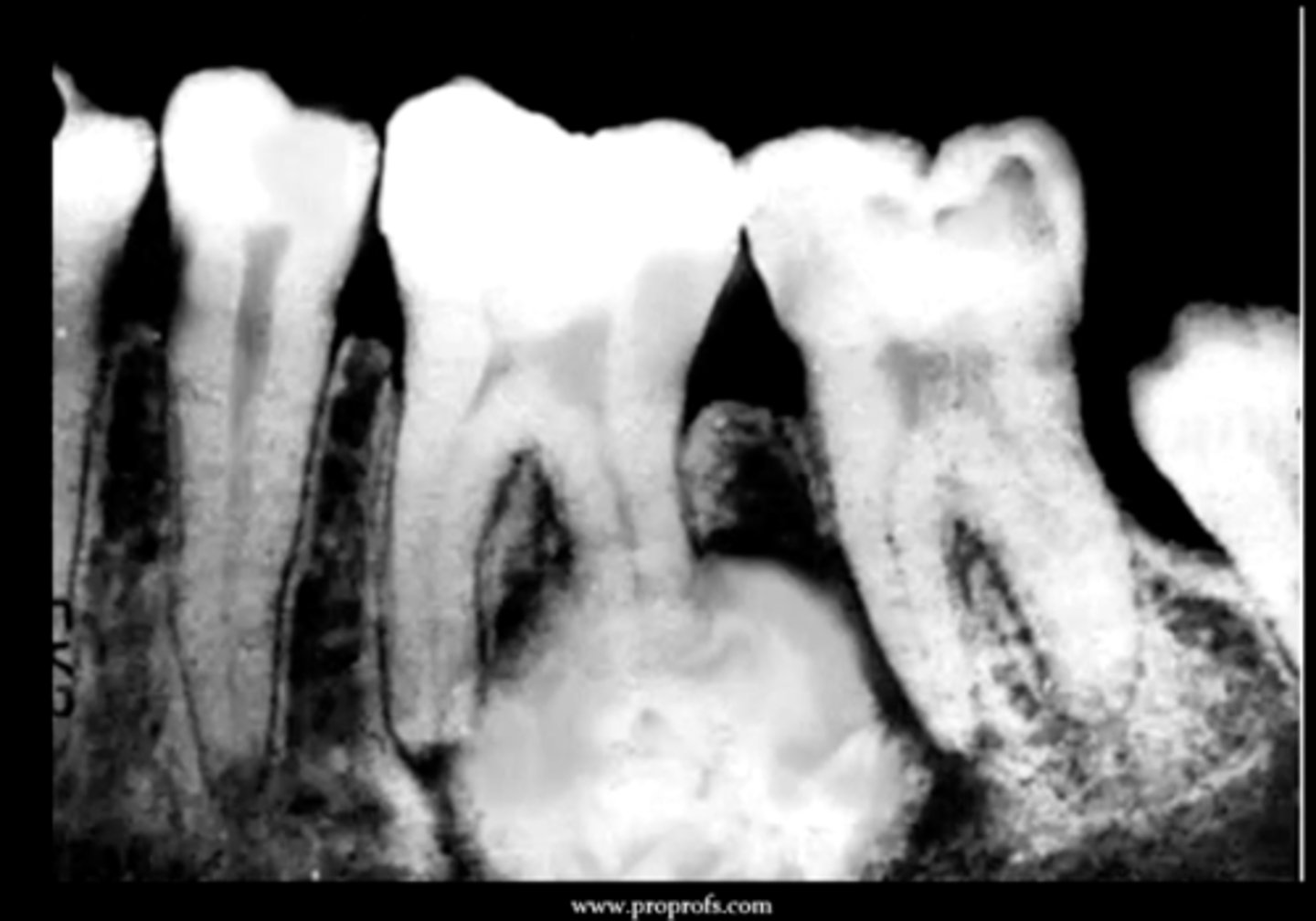 <p>a large ball of cementum at the end of the root that presents as a round radiopacity with a RL border/rim</p><p>histologically, it basically presents as cementum</p>