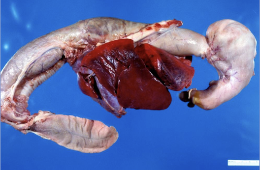 <p>dilation of the esophagus → insufficient, absent, or uncoordinated peristalsis</p>