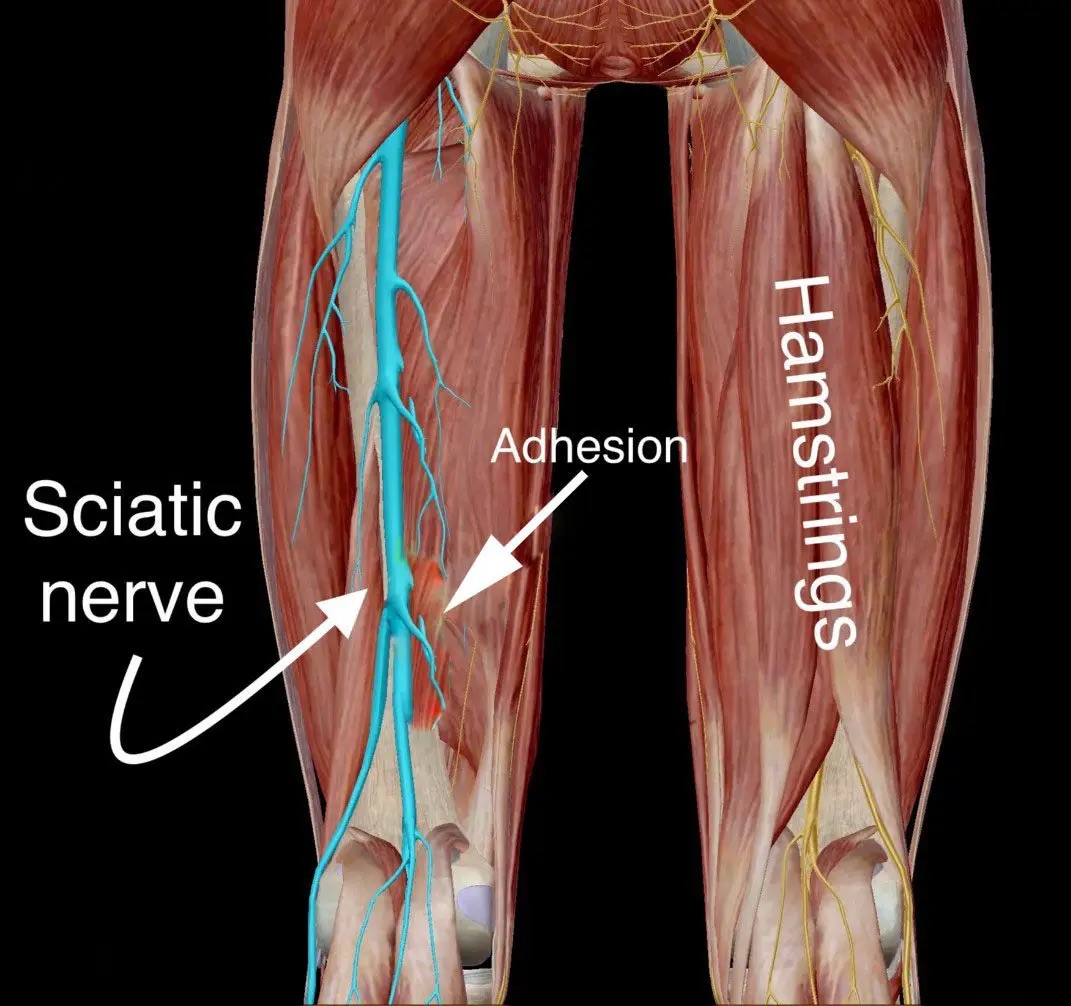 <p>a. Hamstrings</p><div data-type="horizontalRule"><hr></div><p>Quadriceps is innervated by the FEMORAL nerve</p>
