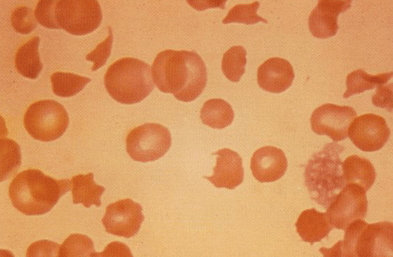 <p>increased fatigue, hx of aortic valve replacement</p>