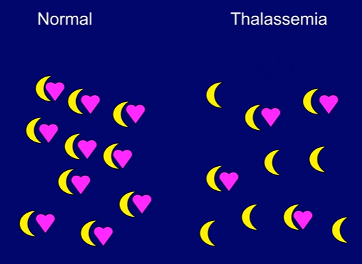 <p>Bệnh giảm tổng hợp các chuỗi globin</p><p>→alpha thalassemia hoặc beta thalassemia …..</p>