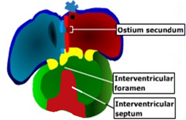 <ol start="3"><li><p><strong><u>Interventricular septum</u></strong></p></li></ol><p>Has 2 parts; <strong><mark data-color="red">muscular part</mark></strong> and <strong><mark data-color="red">membranous part</mark></strong>.</p><p><u><span style="color: red">Muscular part</span></u></p><ul><li><p>A <strong>median </strong>_____ or fold grows from the _____ of the <strong>primordial </strong>_________, near its ____.</p></li><li><p>It represents the ______ <strong>2/3</strong> of the ______.</p></li></ul><p><u><span style="color: red">Membranous part</span></u></p><p>It develops from 2 sources:</p><ul><li><p>Its <strong>anterior 1/3</strong> comes from the ________ ______ ______ (yellow).</p></li><li><p>The <strong>posterior 2/3 </strong>comes from the _________ ___ ______(green).</p></li></ul>