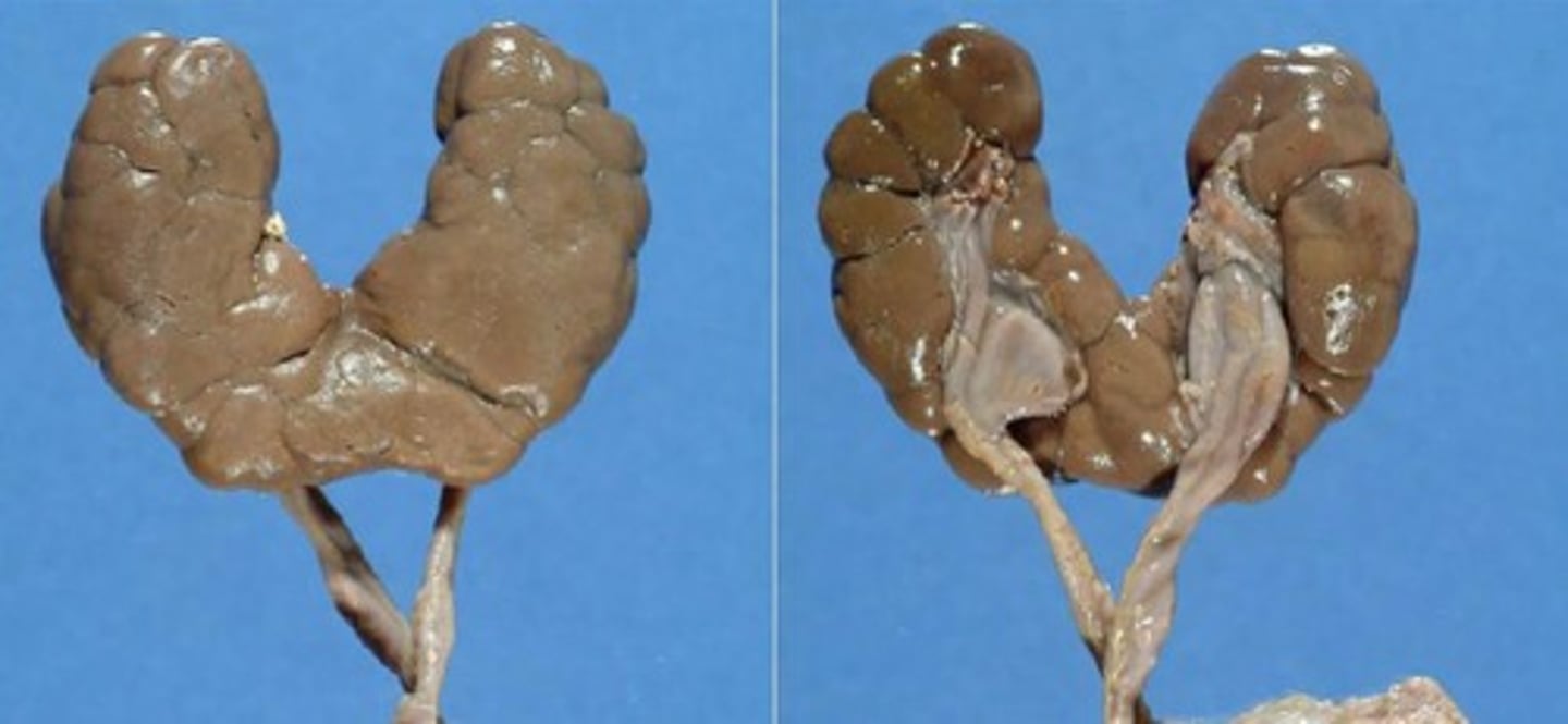 <p>medfött tillstånd där njurarna smälter samman i den nedre delen</p>