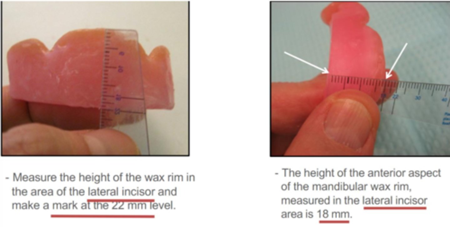 <p>Which method to establish VDO?</p>