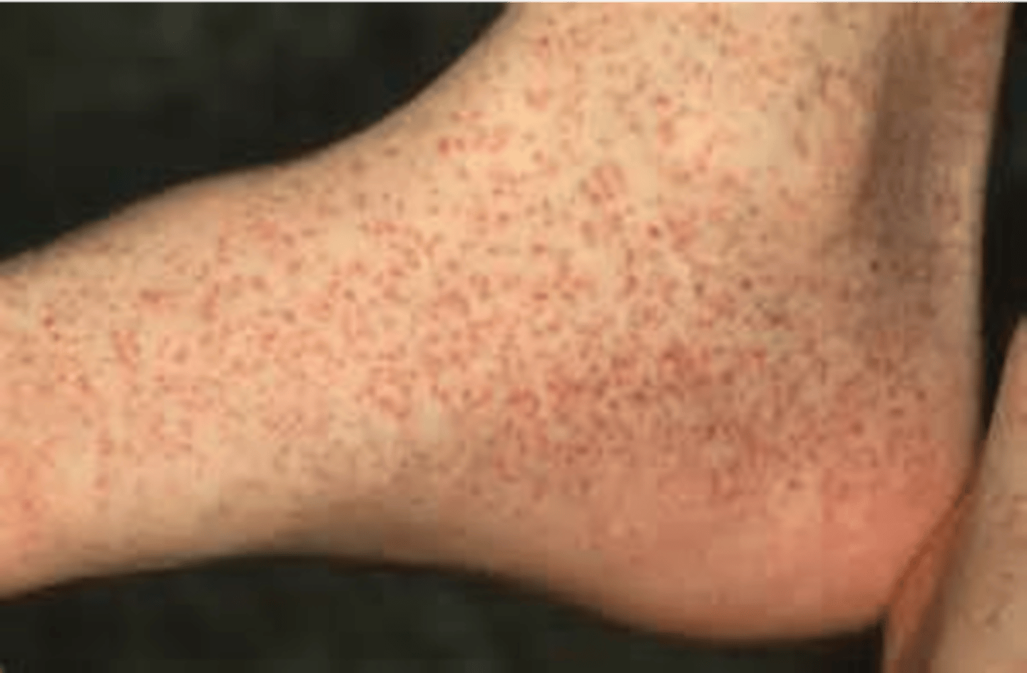 <p>•One petechia</p><p>•Small red or purple spot on the body</p><p>•&lt; 3 mm</p>