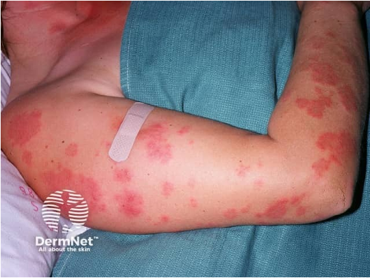 <p>acute (ACLE): transient erythematous patches</p><p>subacute (SCLE): small erythematous scaly papules</p><p>chronic (CCLE): subtypes discoid (DLE) and lupus panniculitis</p>