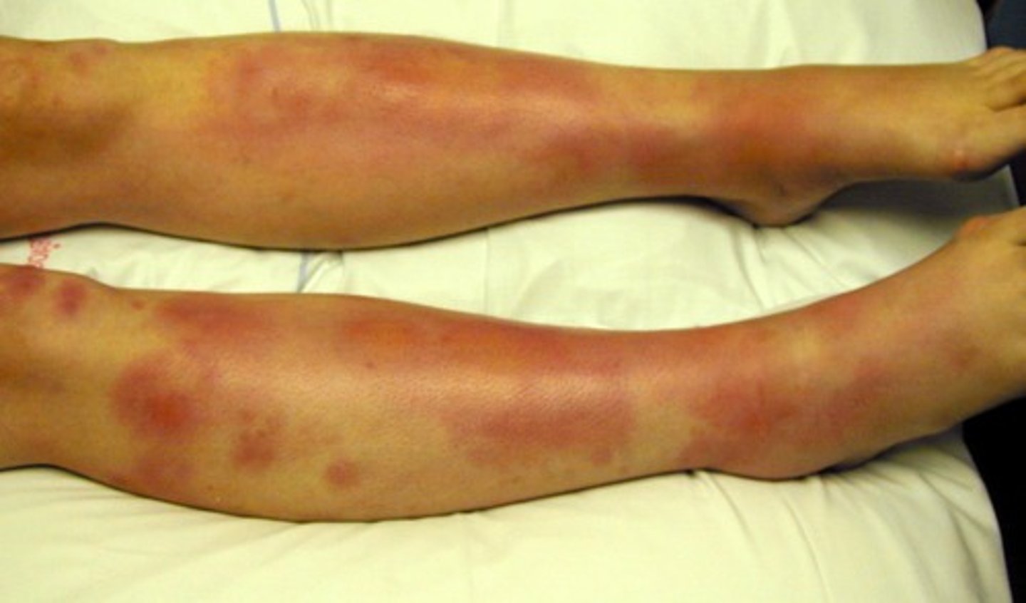 <p>large, painful subq nodules w/ overlying erythema</p><p>-more in females 15-30</p><p>-strep, drug reactions, pregnancy, TB, sarcoidosis, IBS</p>