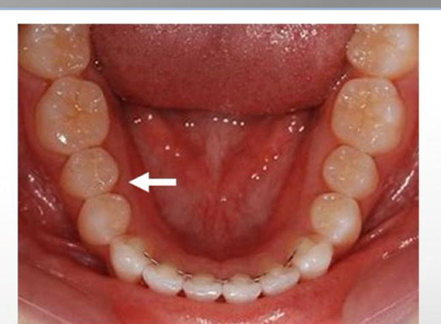 <p>Surface of mandibular and maxillary teeth closest to the tongue</p>