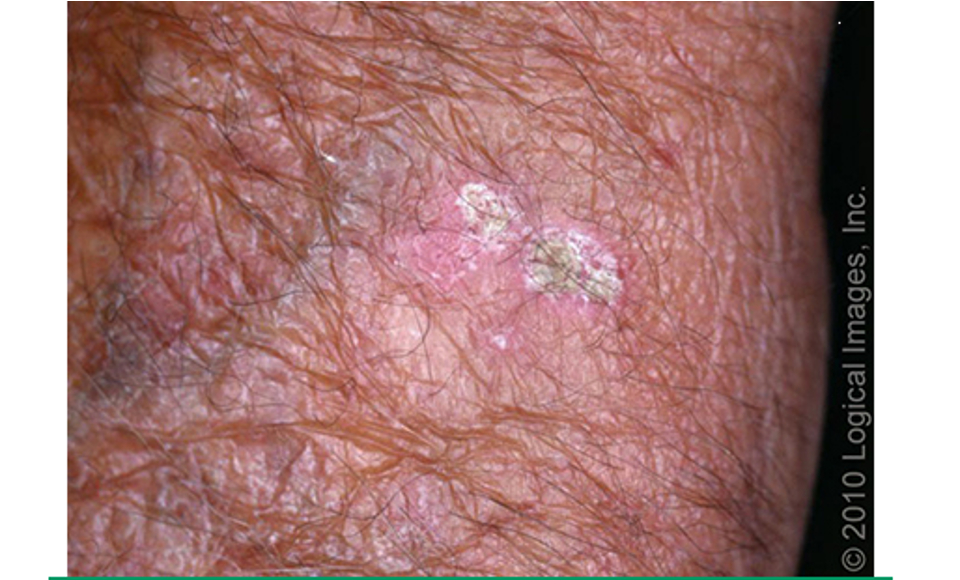 <p><strong>classic type</strong>: erythematous, scaly macule, papule, or plaque w/ dry, rough appearance (most common)</p><p><strong>hypertrophic type</strong>: thick adherent scale on erythematous base</p><p><strong>atrophic type</strong>: scale is absent; lesions appear as smooth red macules</p><p><strong>pigmented:</strong> hyperpigmented scaly macules or patches</p><p><strong>actinic cheilitis</strong>: rough or scaly area on lip</p><p><strong>AK w/ cutaneous horn</strong>: keratitis projection that resembles a cone</p><p>located on sun exposed areas</p>